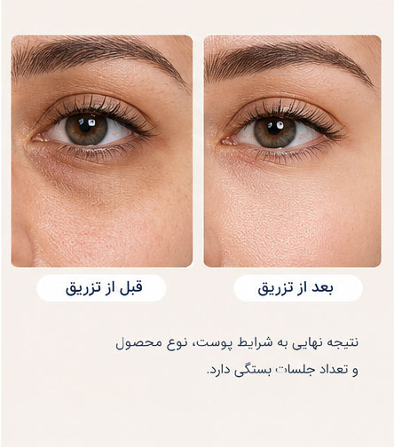 تزریق پی دی آر ان